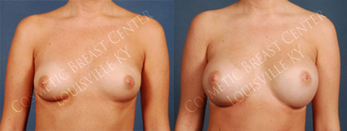 Enlargement - Silicone Before & After Gallery - Patient 110171 - Image 1