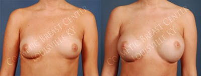 Enlargement - Silicone Before & After Gallery - Patient 110171 - Image 1