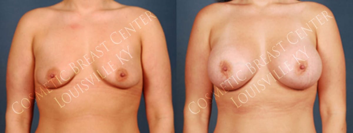 Enlargement - Silicone Before & After Gallery - Patient 119362 - Image 1