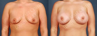 Enlargement - Silicone Before & After Gallery - Patient 119362 - Image 1