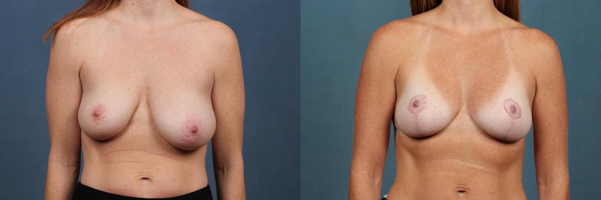 Lift Before & After Gallery - Patient 282143 - Image 1