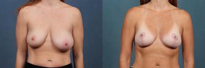 Lift Before & After Gallery - Patient 282143 - Image 1