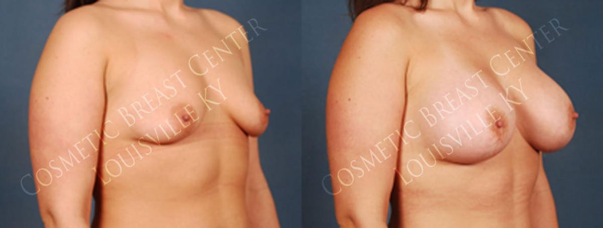 Enlargement - Silicone Before & After Gallery - Patient 119362 - Image 2