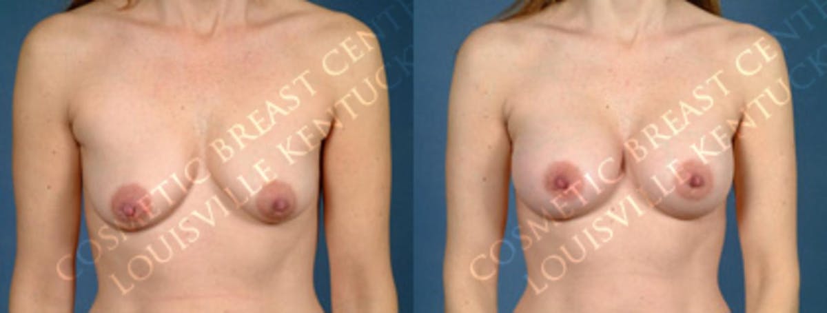 Enlargement - Silicone Before & After Gallery - Patient 348917 - Image 1
