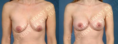 Enlargement - Silicone Before & After Gallery - Patient 348917 - Image 1