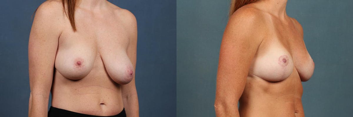 Lift Before & After Gallery - Patient 282143 - Image 3