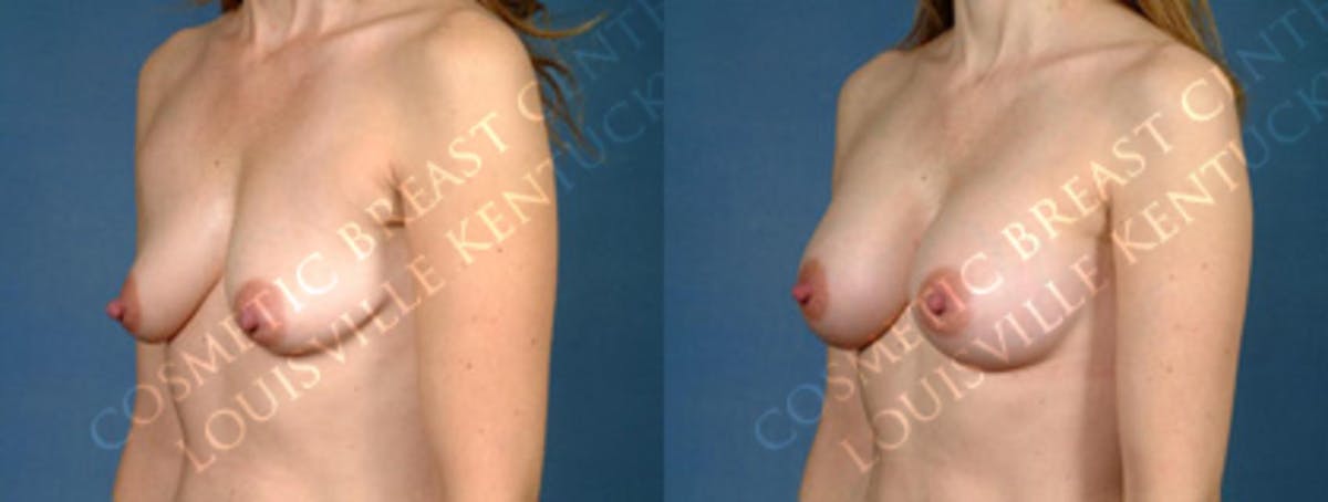 Enlargement - Silicone Before & After Gallery - Patient 348917 - Image 2