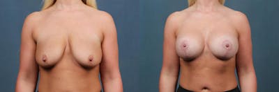 Lift Before & After Gallery - Patient 101282 - Image 1