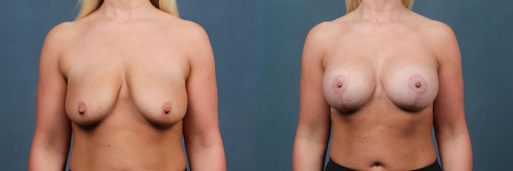 Lift Before & After Gallery - Patient 101282 - Image 1