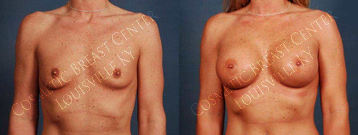 Enlargement - Silicone Before & After Gallery - Patient 292631 - Image 1
