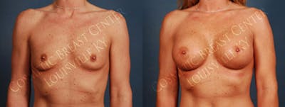 Enlargement - Silicone Before & After Gallery - Patient 292631 - Image 1