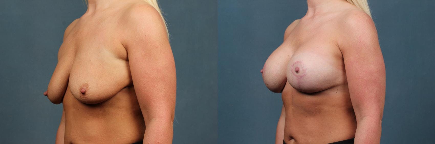 Lift Before & After Gallery - Patient 101282 - Image 2