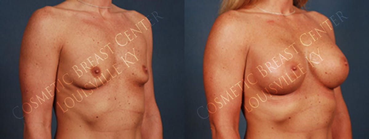 Enlargement - Silicone Before & After Gallery - Patient 292631 - Image 2