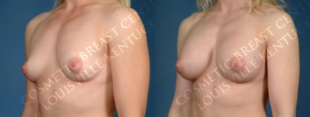 Enlargement - Silicone Before & After Gallery - Patient 153984 - Image 2
