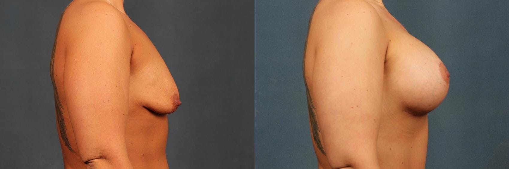 Lift Before & After Gallery - Patient 426246 - Image 2