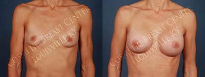 Enlargement - Silicone Before & After Gallery - Patient 985056 - Image 1