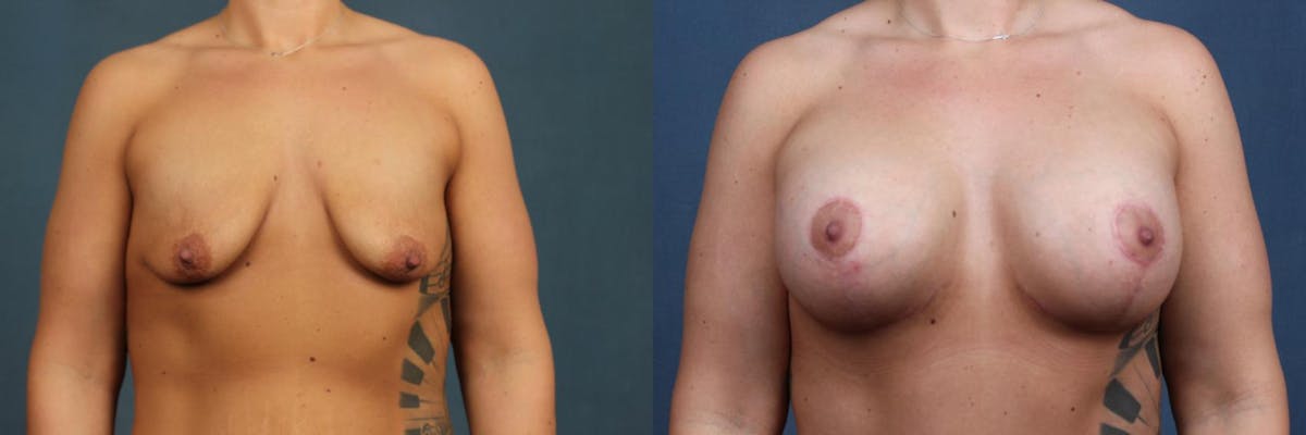 Lift Before & After Gallery - Patient 426246 - Image 3