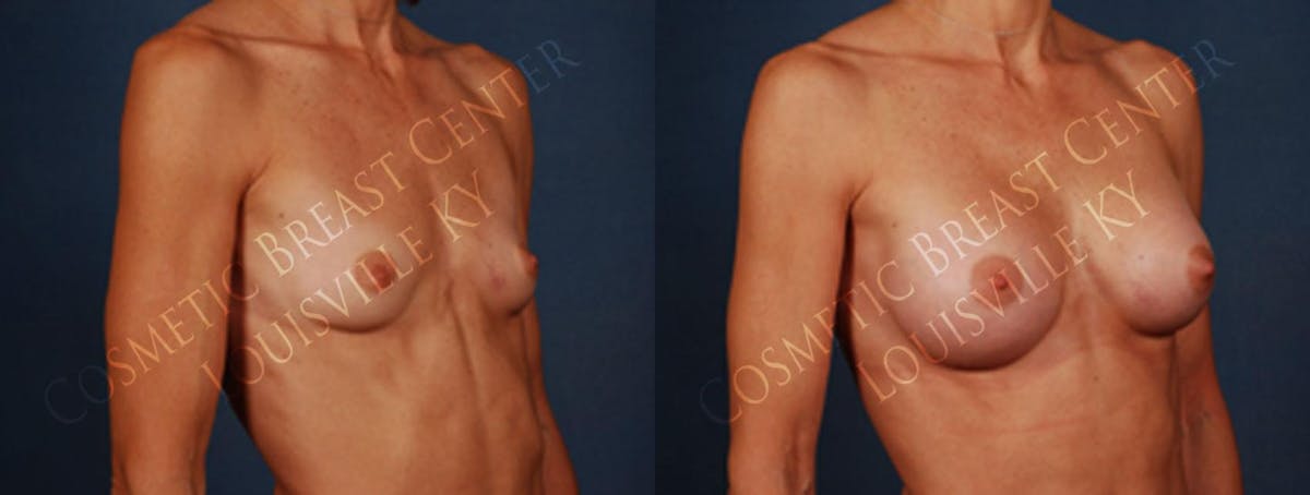 Enlargement - Silicone Before & After Gallery - Patient 985056 - Image 2