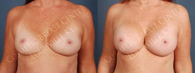 Enlargement - Silicone Before & After Gallery - Patient 307487 - Image 1