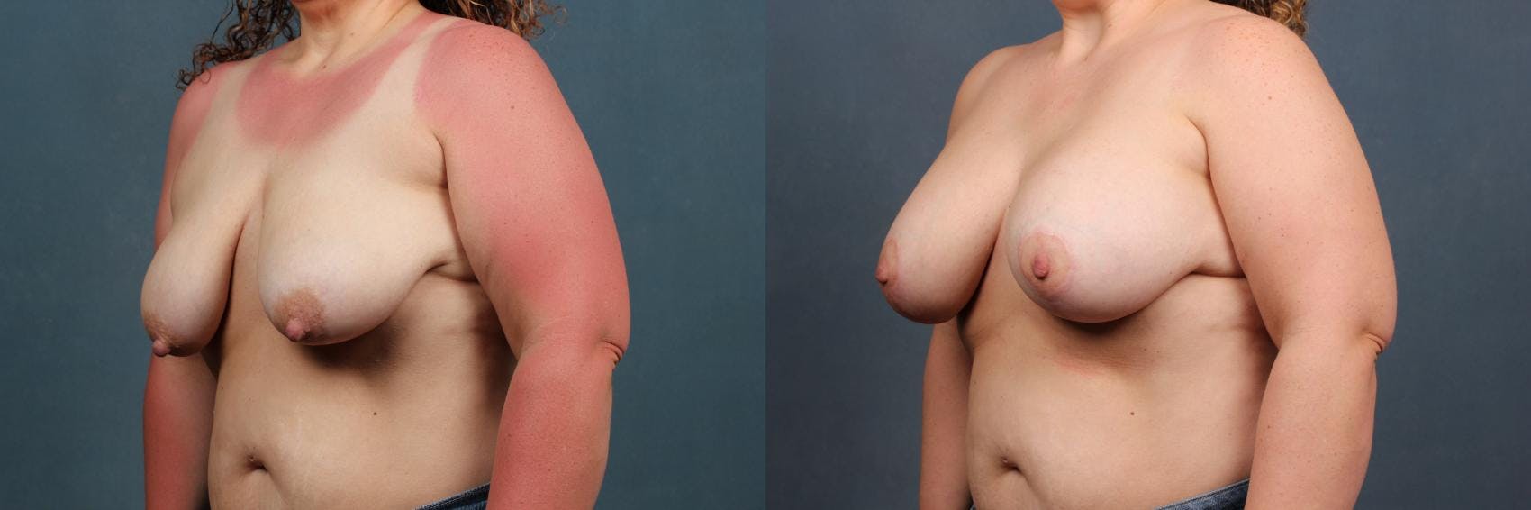 Lift Before & After Gallery - Patient 398524 - Image 2