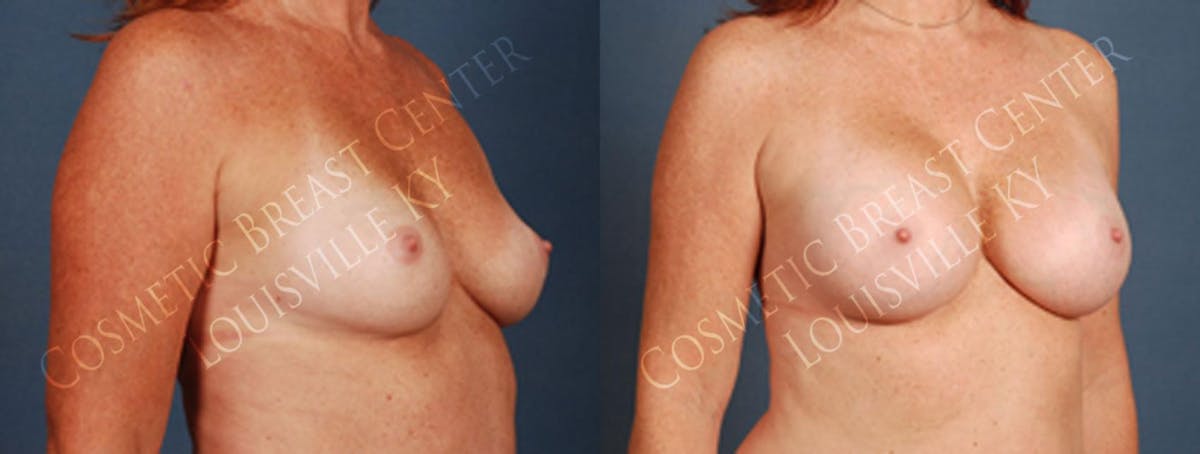 Enlargement - Silicone Before & After Gallery - Patient 307487 - Image 2