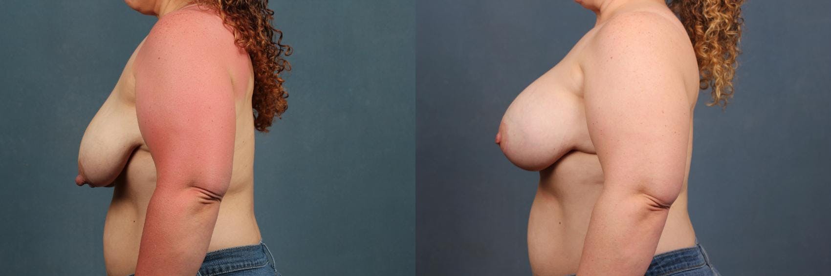 Lift Before & After Gallery - Patient 398524 - Image 3