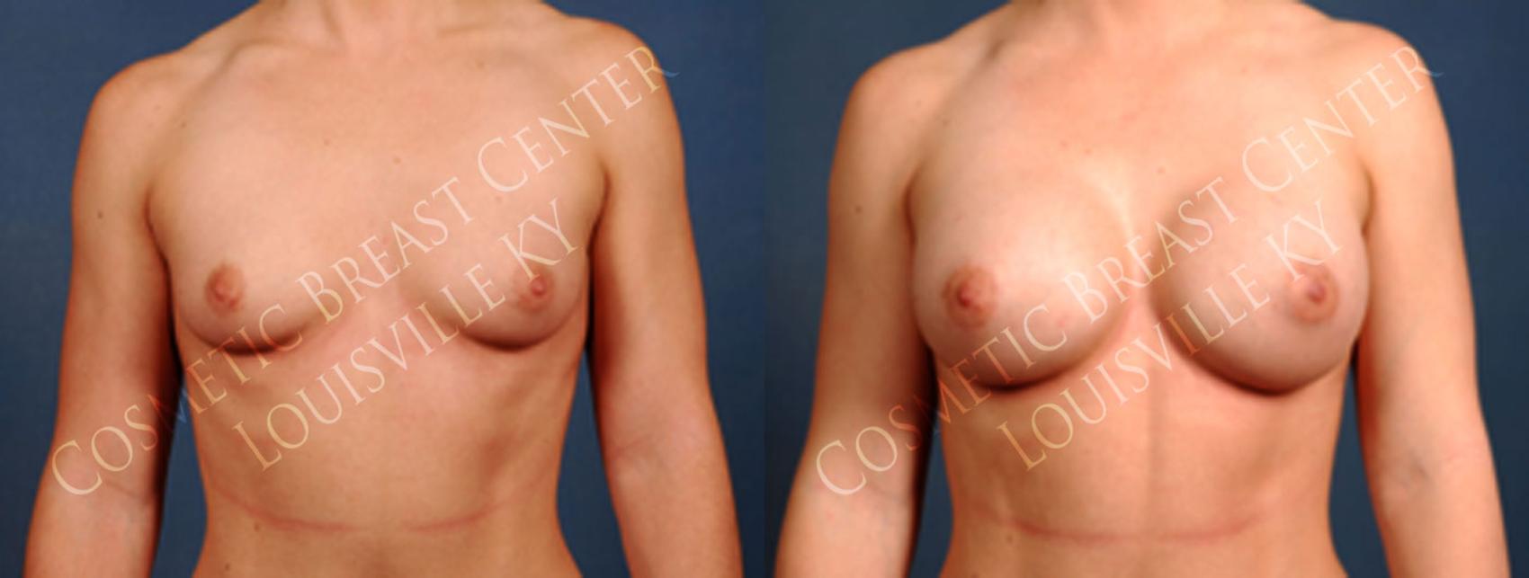 silicone breast augmentation results