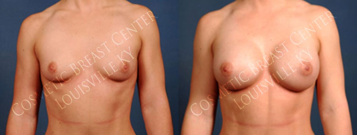 Enlargement - Silicone Before & After Gallery - Patient 367035 - Image 1