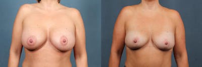 Lift Before & After Gallery - Patient 407968 - Image 1