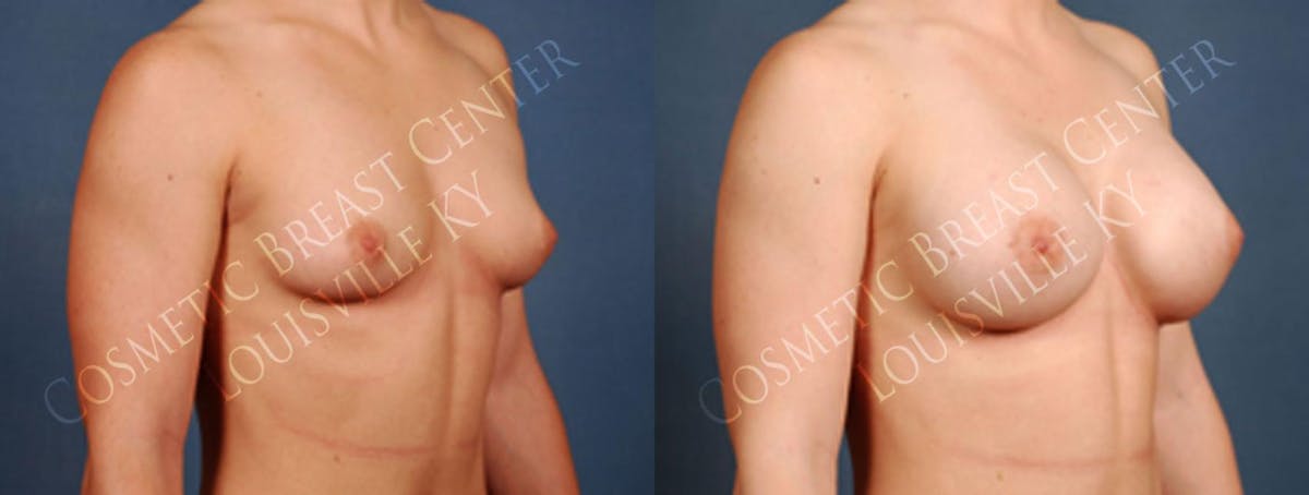 Enlargement - Silicone Before & After Gallery - Patient 367035 - Image 2