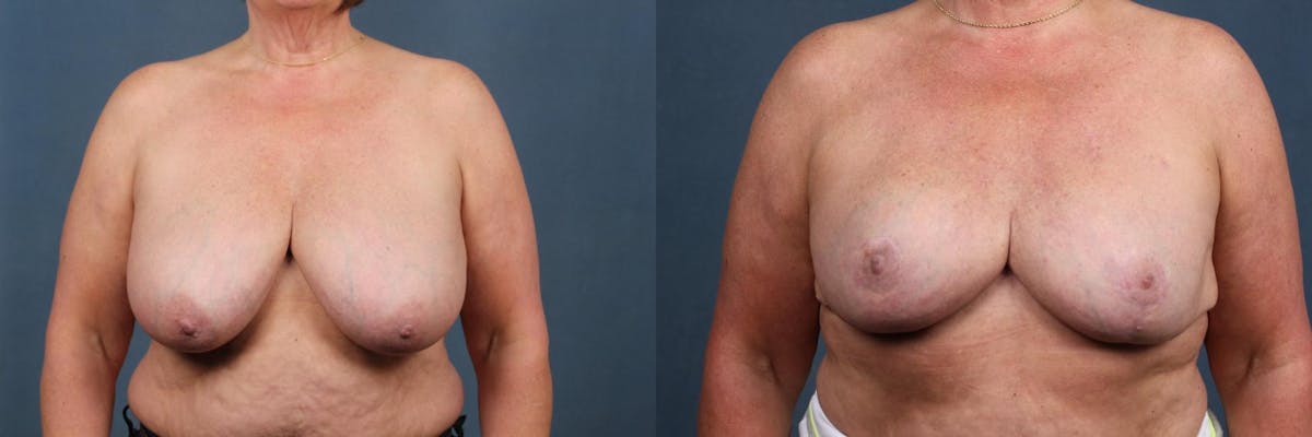 Lift Before & After Gallery - Patient 391808 - Image 1