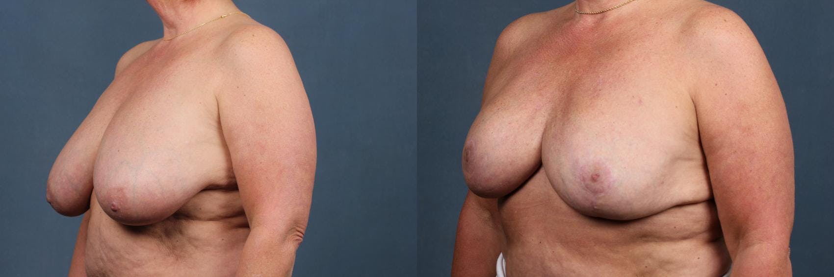 Lift Before & After Gallery - Patient 391808 - Image 2