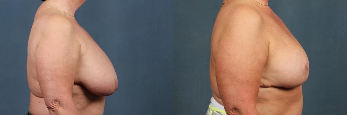 Lift Before & After Gallery - Patient 391808 - Image 3