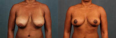 Lift Before & After Gallery - Patient 127389 - Image 1