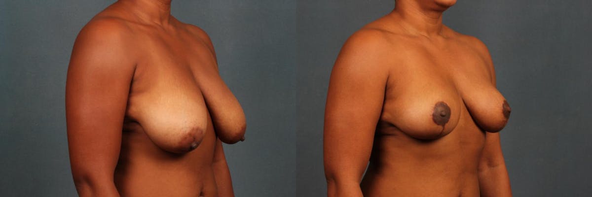 Lift Before & After Gallery - Patient 127389 - Image 2