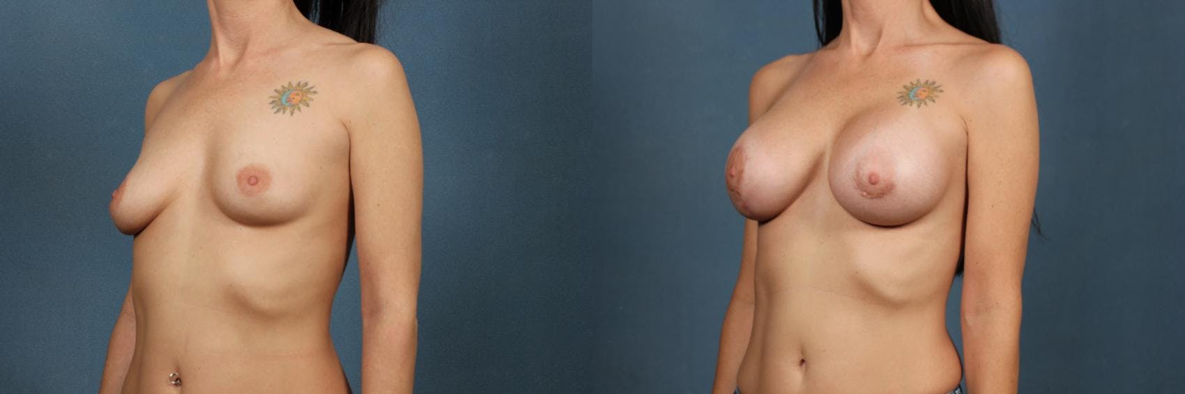 Lift Before & After Gallery - Patient 396823 - Image 2