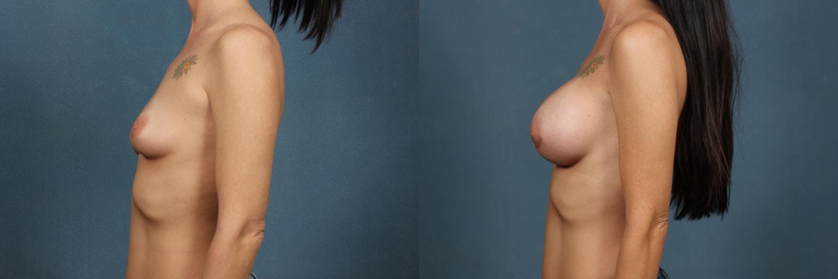 Lift Before & After Gallery - Patient 396823 - Image 3