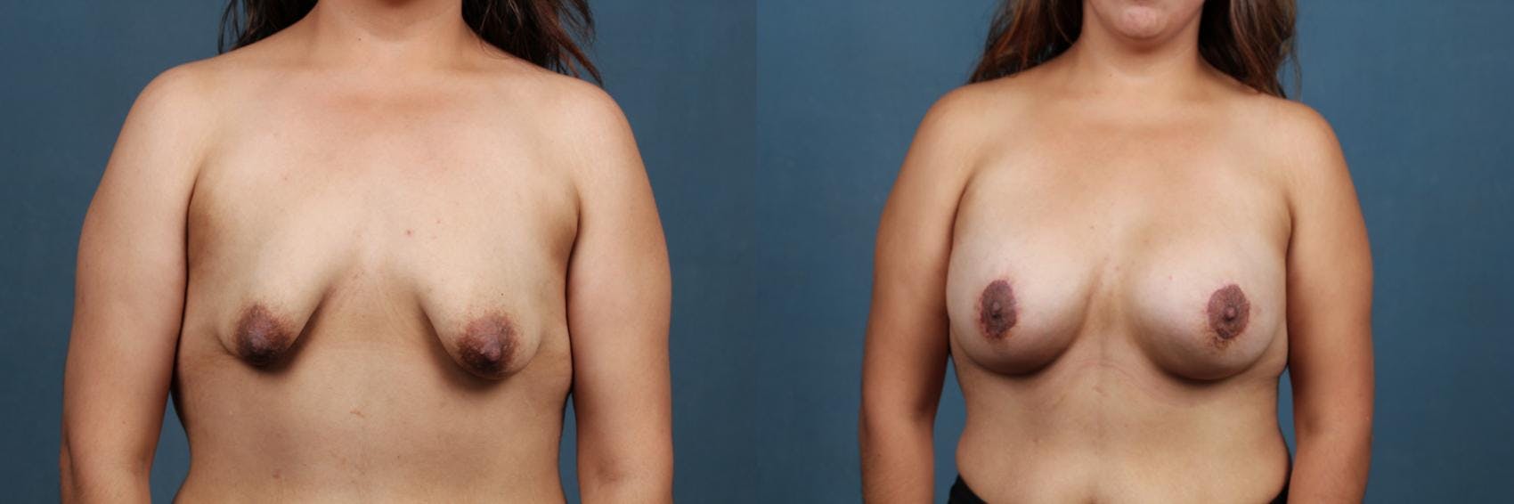 Lift Before & After Gallery - Patient 101211 - Image 1