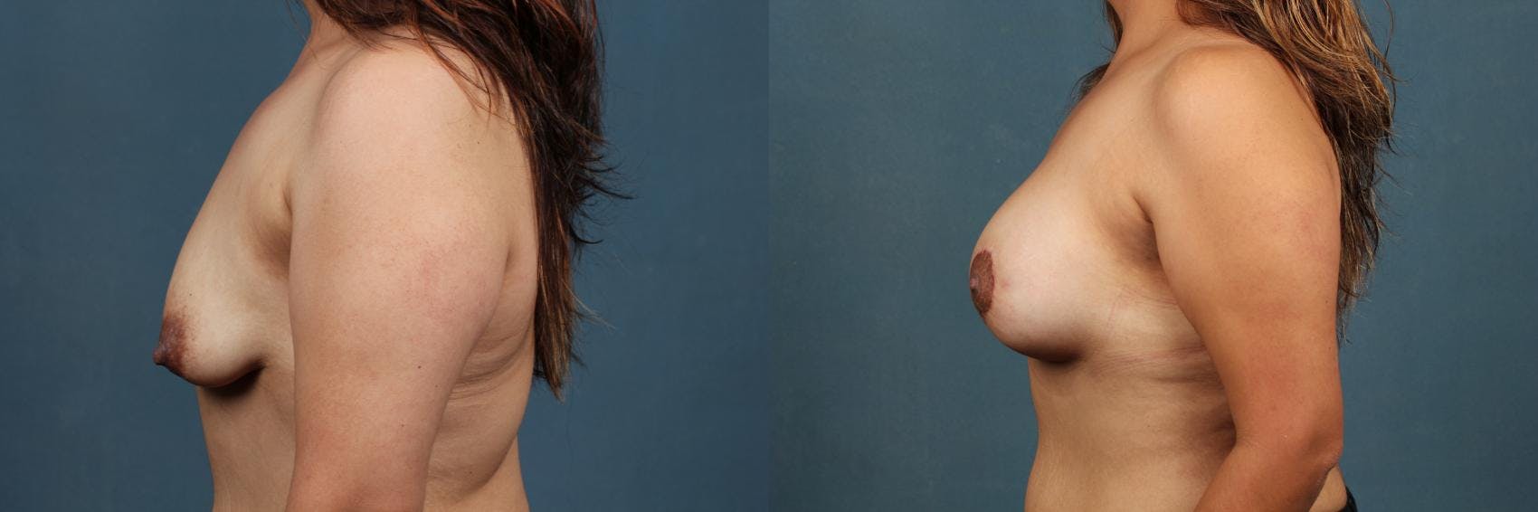 Lift Before & After Gallery - Patient 101211 - Image 3