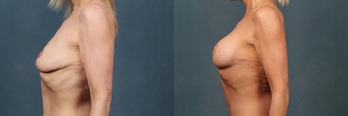 Lift Before & After Gallery - Patient 991579 - Image 3