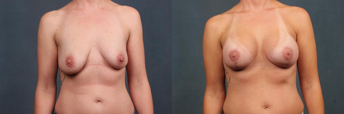 Lift Before & After Gallery - Patient 359675 - Image 1