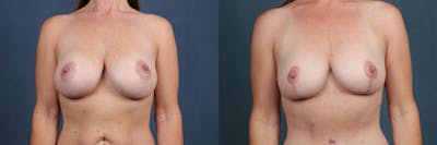 Lift Before & After Gallery - Patient 121484 - Image 1