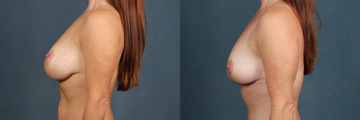 Lift Before & After Gallery - Patient 121484 - Image 2