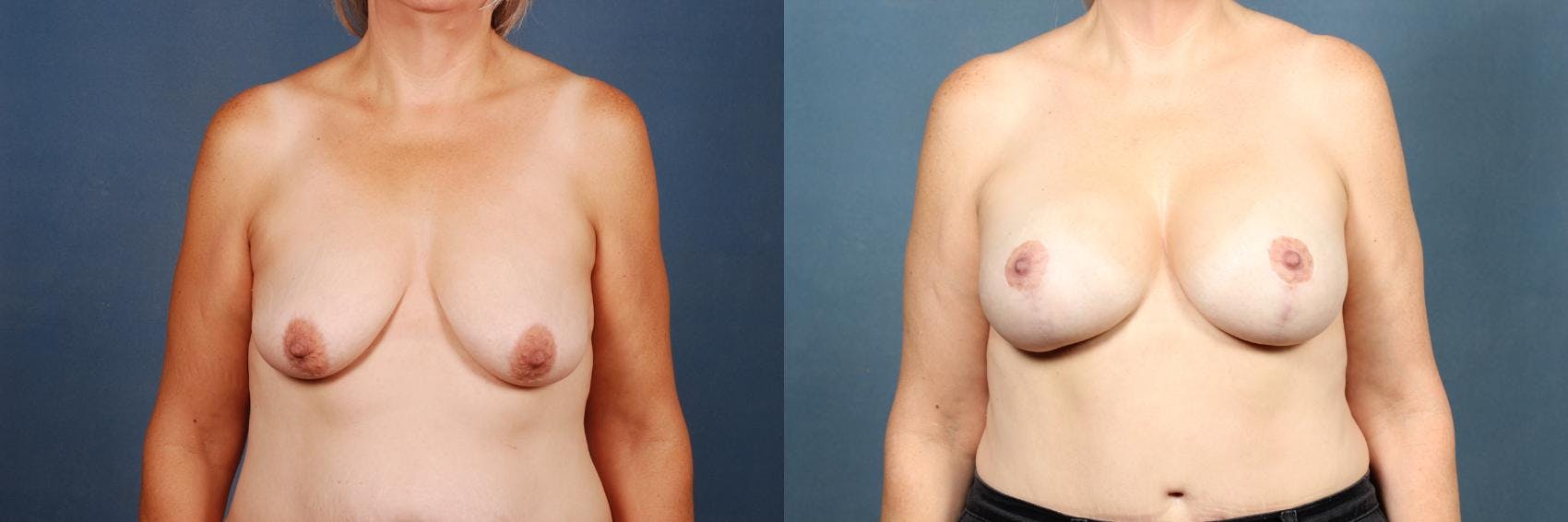 Lift Before & After Gallery - Patient 323791 - Image 1