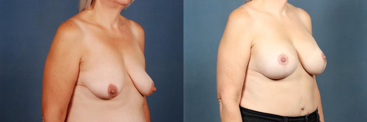 Lift Before & After Gallery - Patient 323791 - Image 2