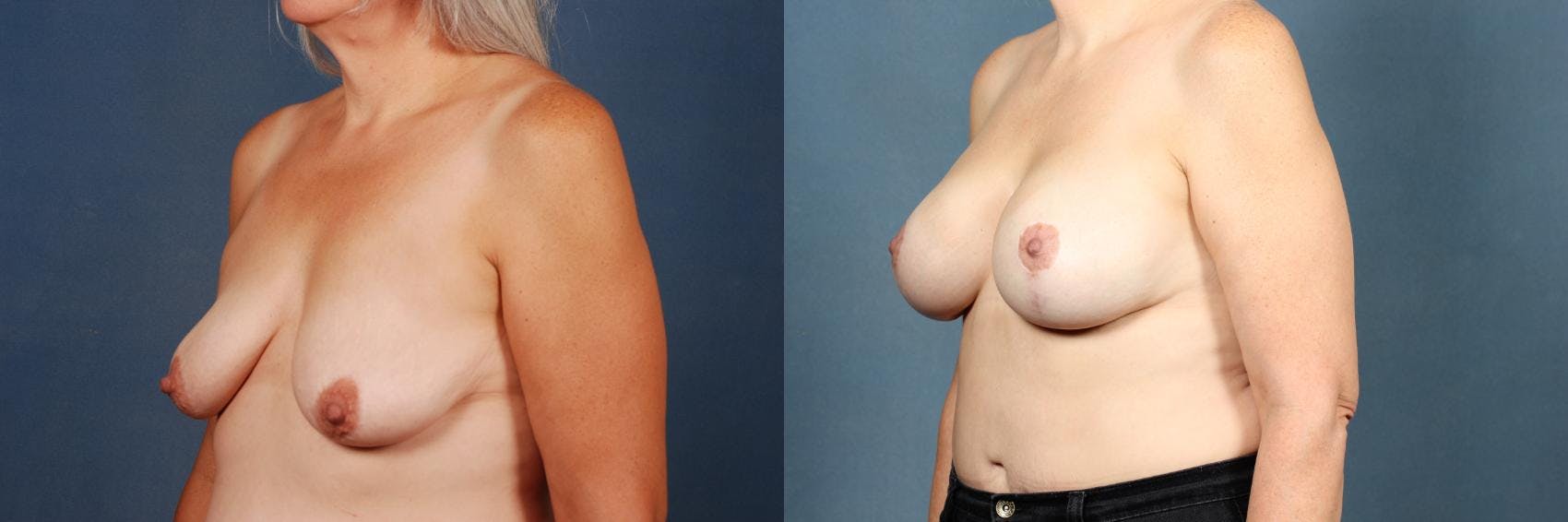 Lift Before & After Gallery - Patient 323791 - Image 3