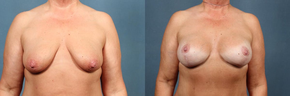Lift Before & After Gallery - Patient 103947 - Image 1
