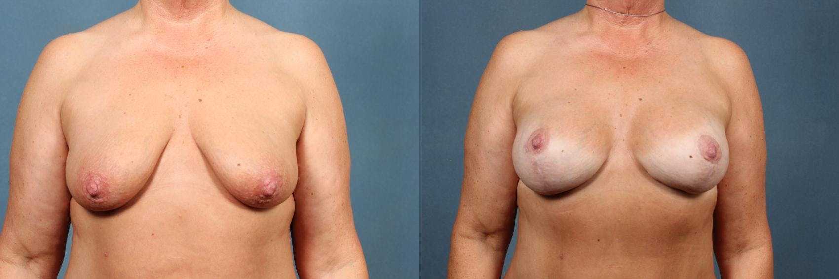Lift Before & After Gallery - Patient 103947 - Image 1