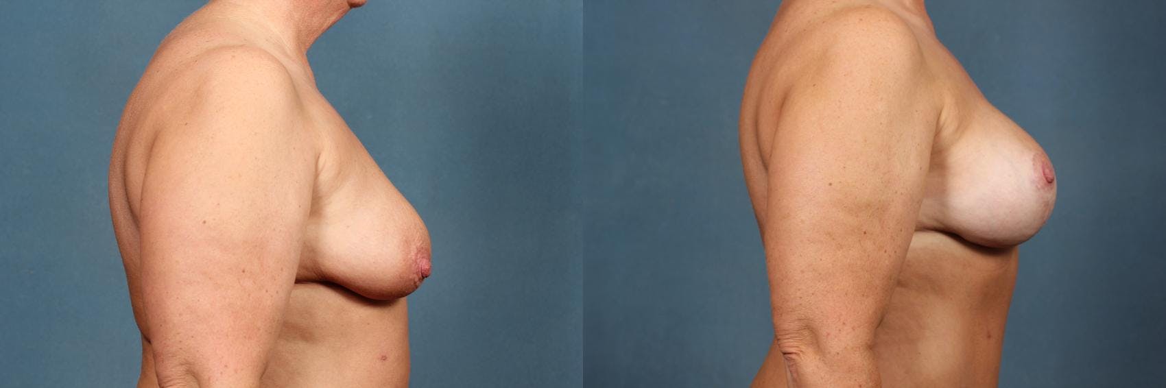 Lift Before & After Gallery - Patient 103947 - Image 2