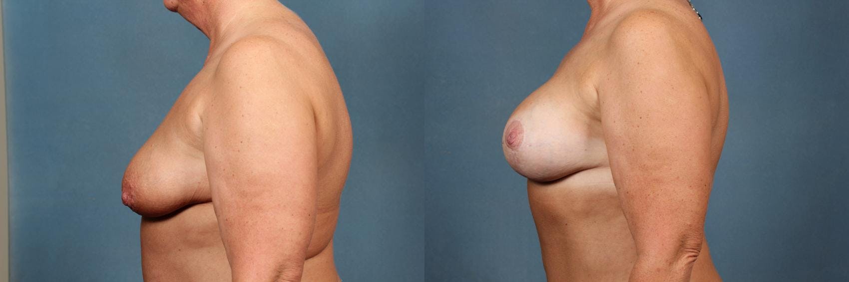 Lift Before & After Gallery - Patient 103947 - Image 3